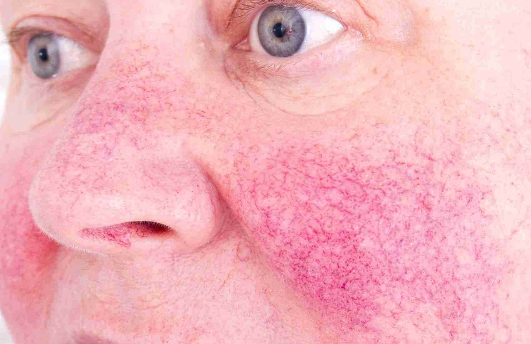 5 Natural Remedies To Get Rid Of Rosacea - Market Bosworth Nude Pic Hq
